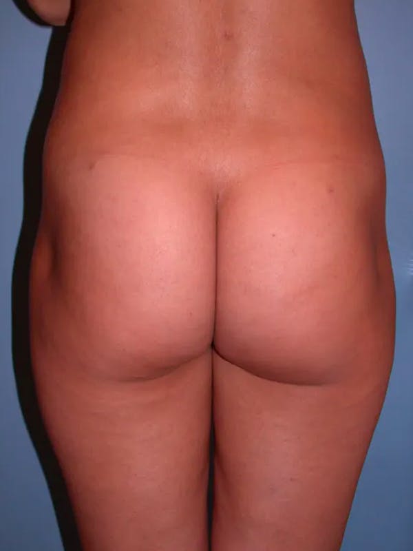 Brazilian Butt Lift Before & After Gallery - Patient 4752150 - Image 3