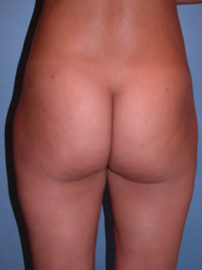 Brazilian Butt Lift Gallery Before & After Gallery - Patient 4752150 - Image 4