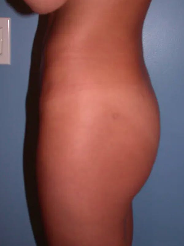 Brazilian Butt Lift Gallery Before & After Gallery - Patient 4752150 - Image 5