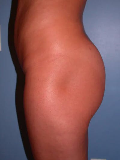 Brazilian Butt Lift Gallery Before & After Gallery - Patient 4752150 - Image 6
