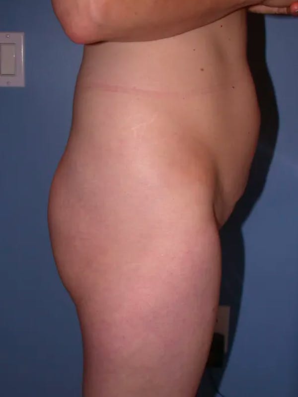 Brazilian Butt Lift Gallery Before & After Gallery - Patient 4752151 - Image 1
