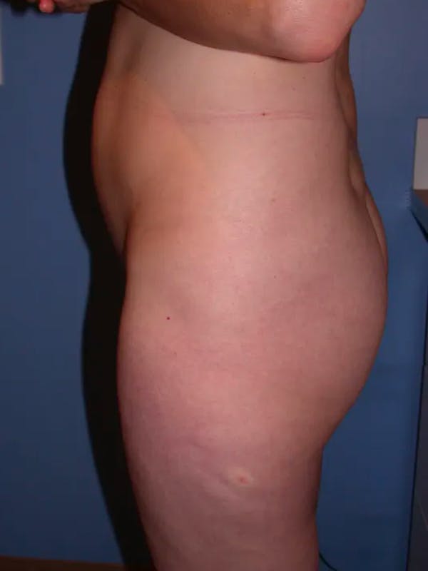 Brazilian Butt Lift Gallery Before & After Gallery - Patient 4752151 - Image 3