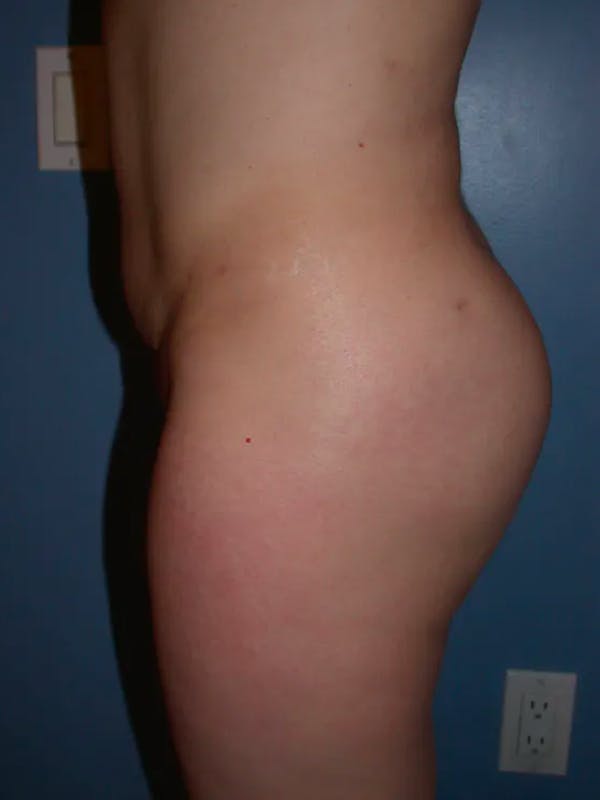 Brazilian Butt Lift Gallery Before & After Gallery - Patient 4752151 - Image 4