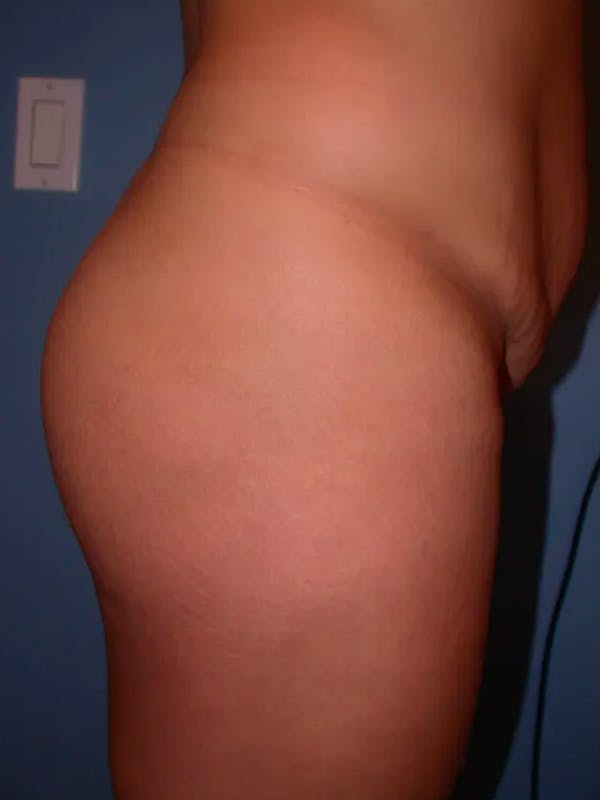 Brazilian Butt Lift Before & After Gallery - Patient 4752152 - Image 1