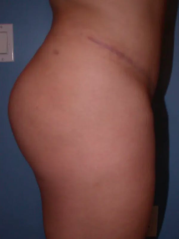 Brazilian Butt Lift Gallery Before & After Gallery - Patient 4752152 - Image 2