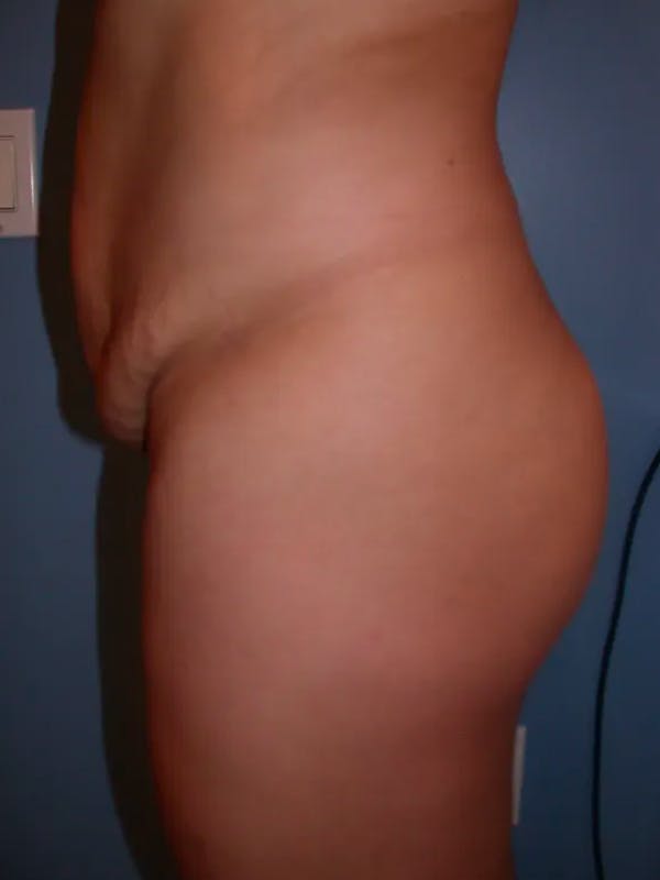 Brazilian Butt Lift Gallery Before & After Gallery - Patient 4752152 - Image 3