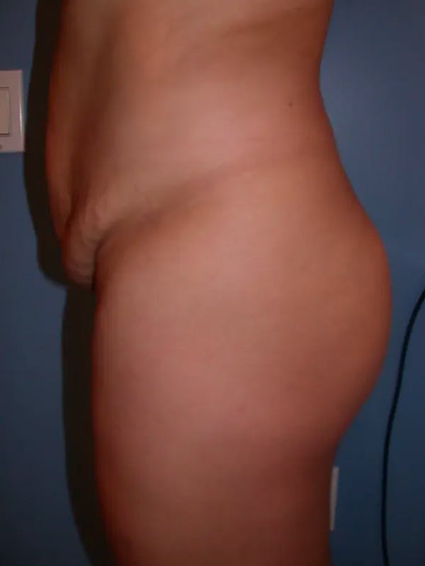 Brazilian Butt Lift Before & After Gallery - Patient 4752152 - Image 3