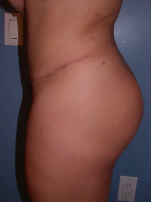 Brazilian Butt Lift Gallery Before & After Gallery - Patient 4752152 - Image 4