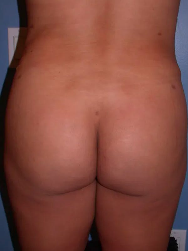 Brazilian Butt Lift Gallery Before & After Gallery - Patient 4752152 - Image 8