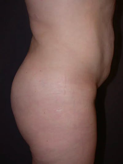Brazilian Butt Lift Gallery Before & After Gallery - Patient 4752155 - Image 4