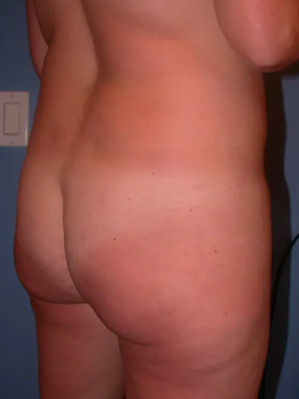Brazilian Butt Lift Gallery Before & After Gallery - Patient 4752155 - Image 5