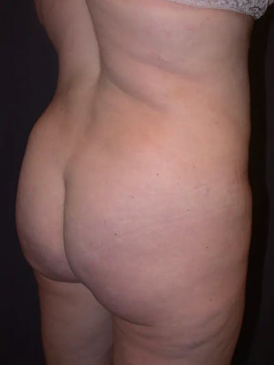 Brazilian Butt Lift Gallery Before & After Gallery - Patient 4752155 - Image 6