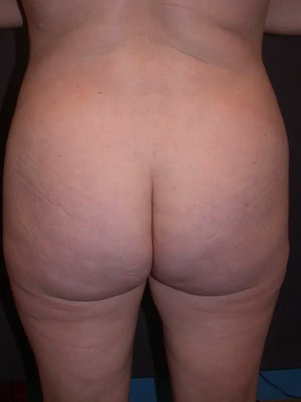 Brazilian Butt Lift Gallery Before & After Gallery - Patient 4752155 - Image 8