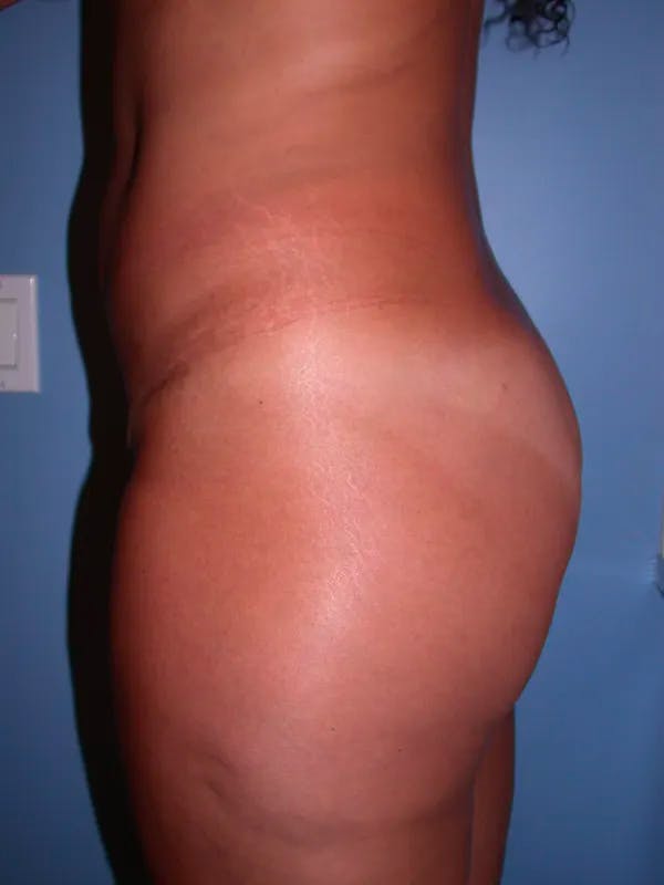Brazilian Butt Lift Gallery Before & After Gallery - Patient 4752157 - Image 3