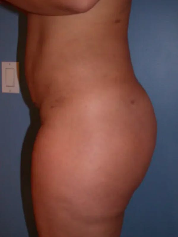 Brazilian Butt Lift Gallery Before & After Gallery - Patient 4752157 - Image 4
