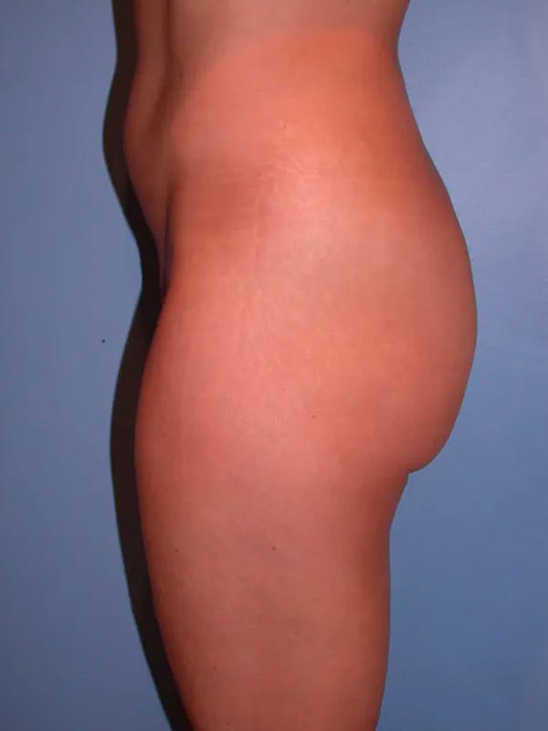 Brazilian Butt Lift Gallery Before & After Gallery - Patient 4752162 - Image 3