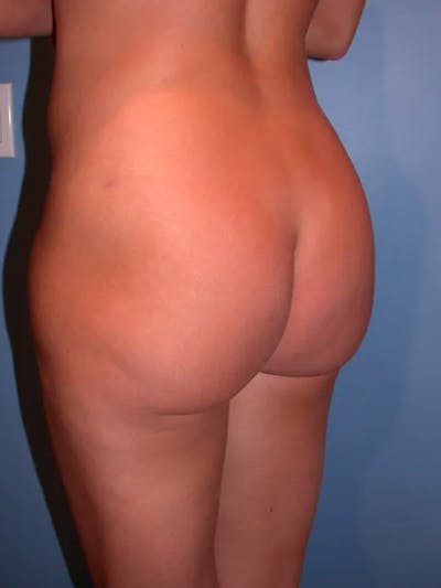 Brazilian Butt Lift Gallery Before & After Gallery - Patient 4752162 - Image 6