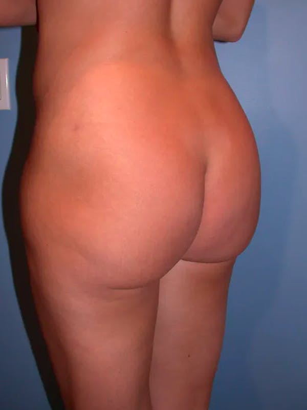 Brazilian Butt Lift Gallery Before & After Gallery - Patient 4752162 - Image 6