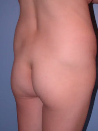Brazilian Butt Lift Gallery Before & After Gallery - Patient 4752163 - Image 1