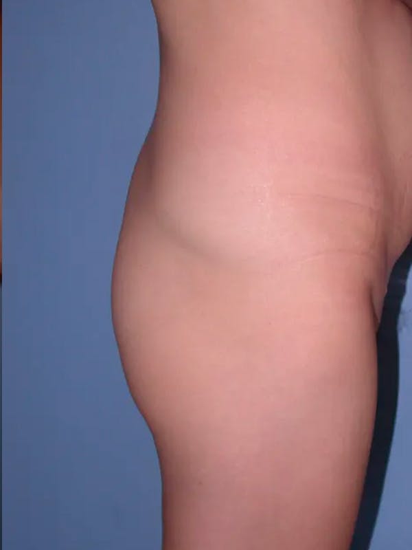 Brazilian Butt Lift Gallery Before & After Gallery - Patient 4752163 - Image 5
