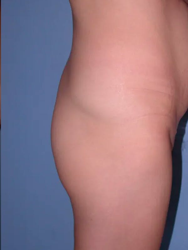 Brazilian Butt Lift Gallery - Patient 4752163 - Image 5