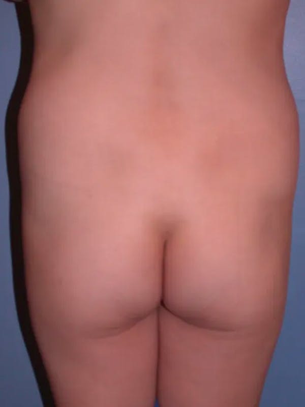 Brazilian Butt Lift Gallery Before & After Gallery - Patient 4752163 - Image 7