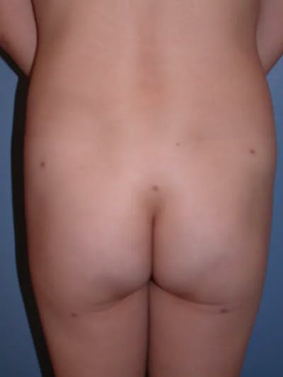 Brazilian Butt Lift Gallery Before & After Gallery - Patient 4752163 - Image 8