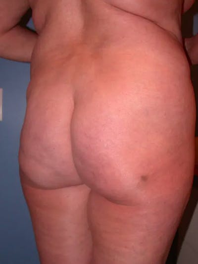 Brazilian Butt Lift Gallery - Patient 4752164 - Image 1