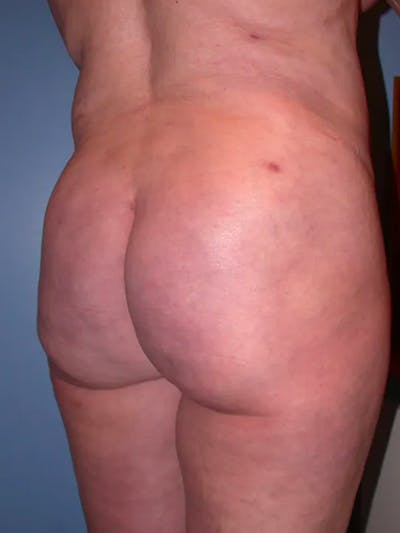 Brazilian Butt Lift Gallery - Patient 4752164 - Image 2