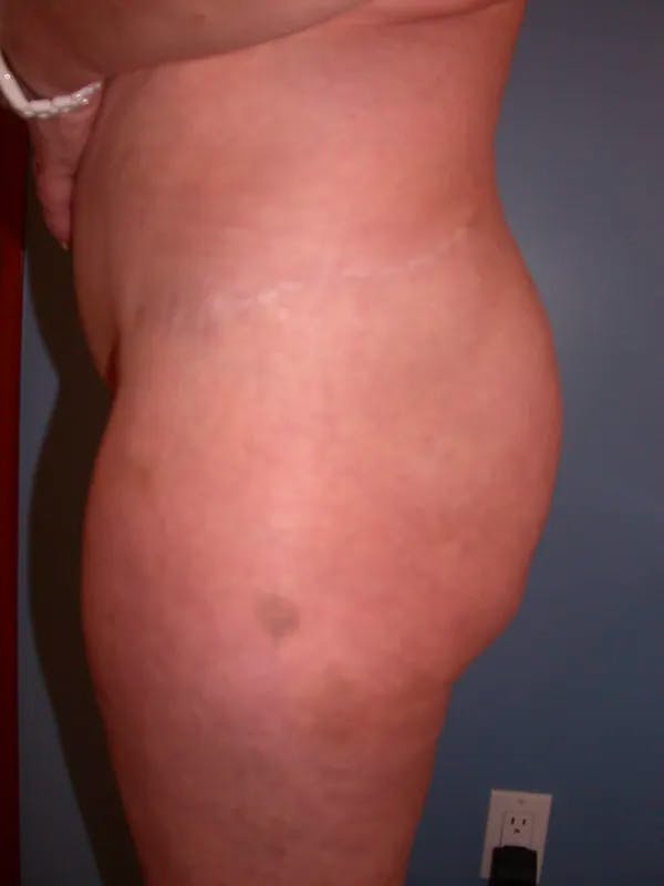 Brazilian Butt Lift Gallery Before & After Gallery - Patient 4752164 - Image 3