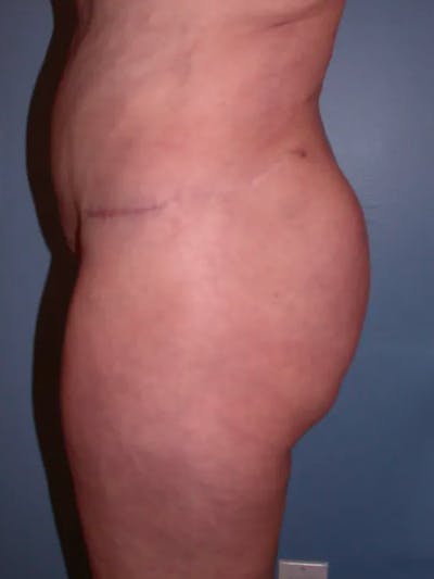 Brazilian Butt Lift Gallery Before & After Gallery - Patient 4752164 - Image 4