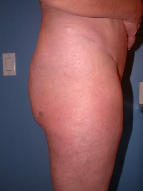 Brazilian Butt Lift Gallery Before & After Gallery - Patient 4752164 - Image 5