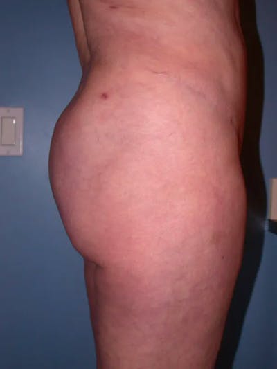 Brazilian Butt Lift Gallery Before & After Gallery - Patient 4752164 - Image 6
