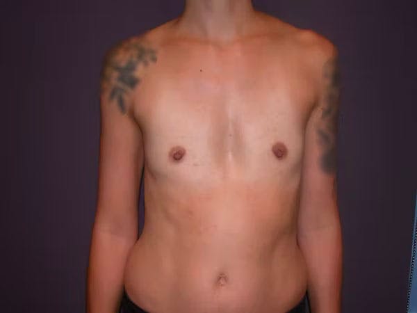 Breast Augmentation Before & After Gallery - Patient 4757509 - Image 1