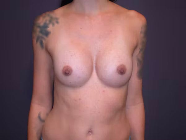 Breast Augmentation Before & After Gallery - Patient 4757509 - Image 2