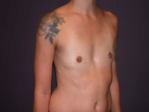 Breast Augmentation Gallery Before & After Gallery - Patient 4757509 - Image 3