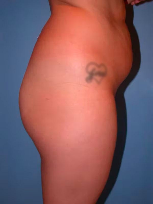 Brazilian Butt Lift Gallery Before & After Gallery - Patient 4752153 - Image 5