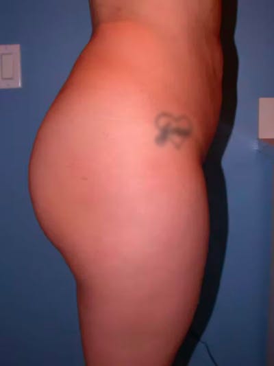 Brazilian Butt Lift Gallery Before & After Gallery - Patient 4752153 - Image 6