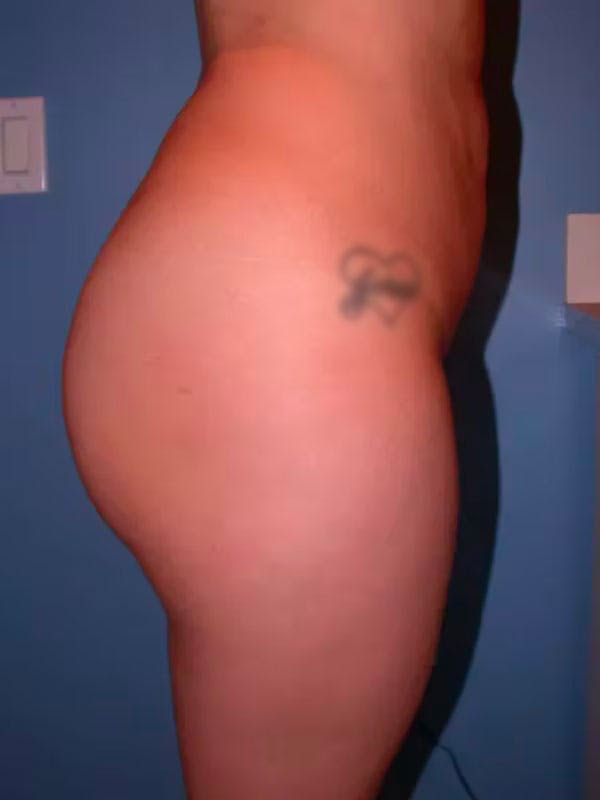 Brazilian Butt Lift Gallery Before & After Gallery - Patient 4752153 - Image 6