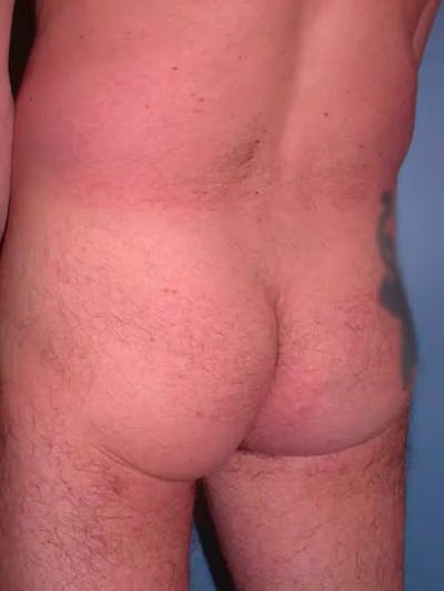 Male Brazilian Butt Lift Before & After Gallery - Patient 6097229 - Image 1