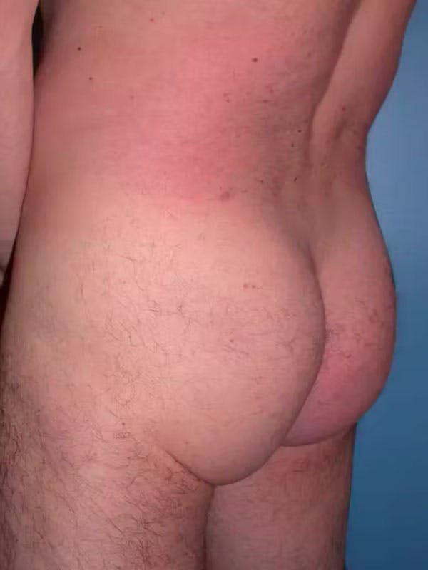 Brazilian Butt Lift Gallery - Patient 4752156 - Image 2