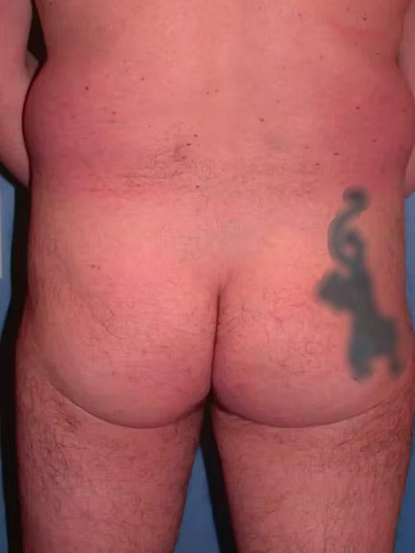 Male Brazilian Butt Lift Before & After Gallery - Patient 6097229 - Image 3