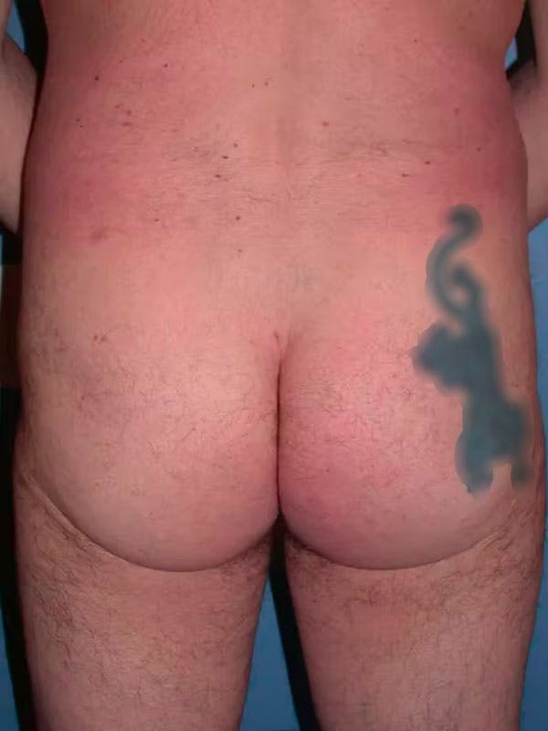 Male Brazilian Butt Lift Gallery Before & After Gallery - Patient 6097229 - Image 4