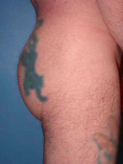 Male Brazilian Butt Lift Before & After Gallery - Patient 6097229 - Image 6