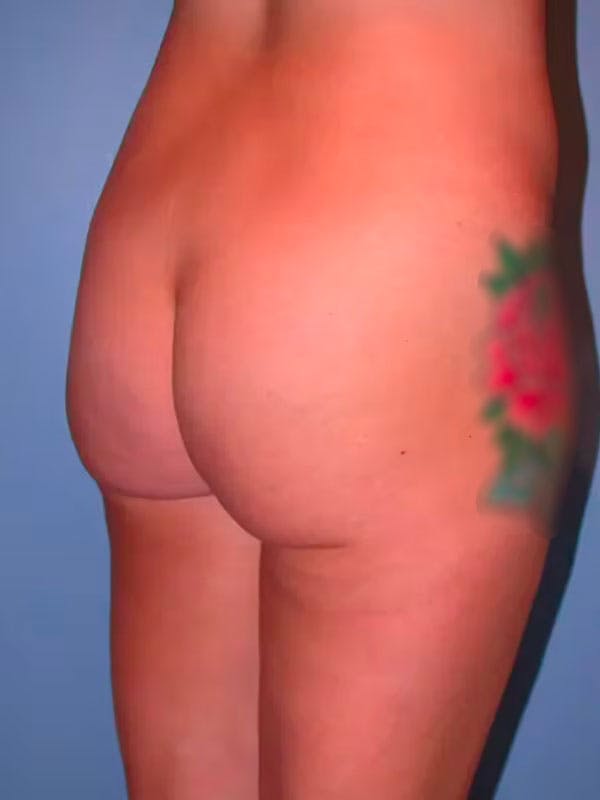 Brazilian Butt Lift Before & After Gallery - Patient 4752162 - Image 1