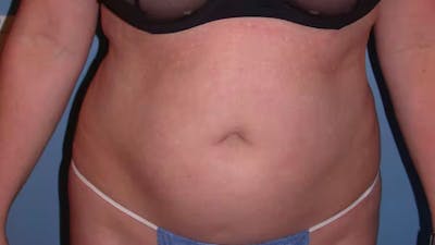 Liposuction Gallery Before & After Gallery - Patient 4752169 - Image 1