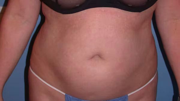 Liposuction Before & After Gallery - Patient 4752169 - Image 1