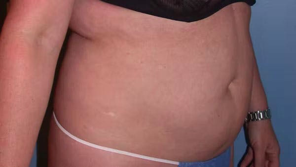 Liposuction Before & After Gallery - Patient 4752169 - Image 7