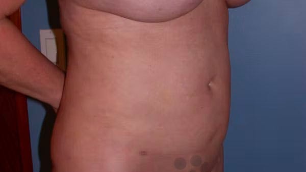 Liposuction Gallery Before & After Gallery - Patient 4752169 - Image 8