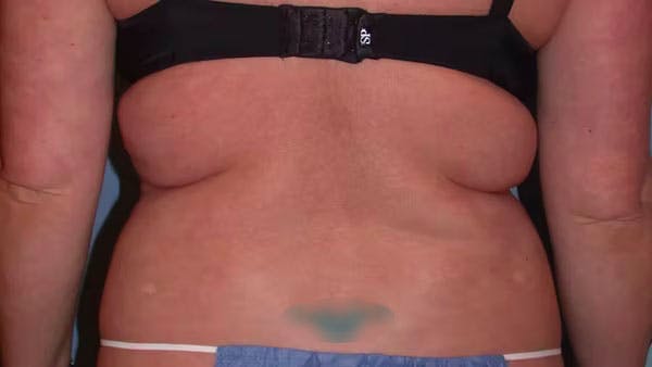 Liposuction Gallery Before & After Gallery - Patient 4752169 - Image 9